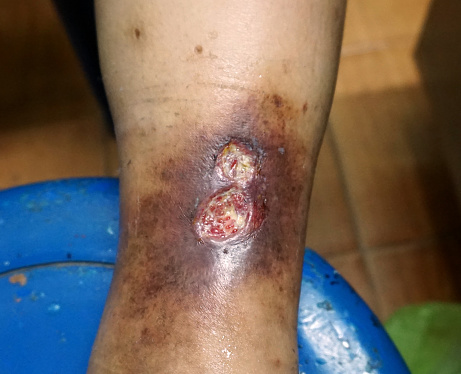Venous Stasis Ulcer